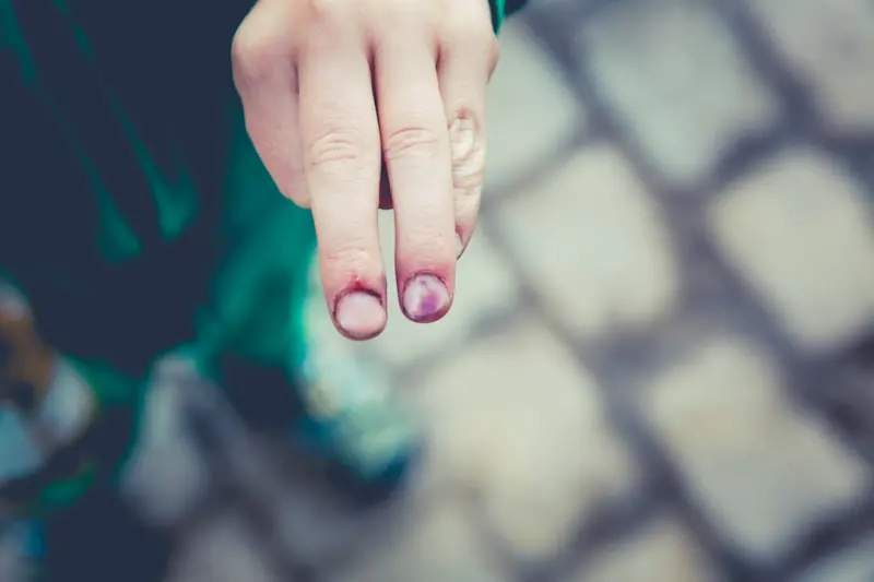 Beyond the Bruise: Uncovering Hidden Costs in Personal Injury Cases